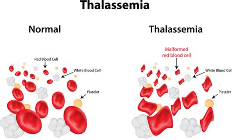 what is beta thalassemia